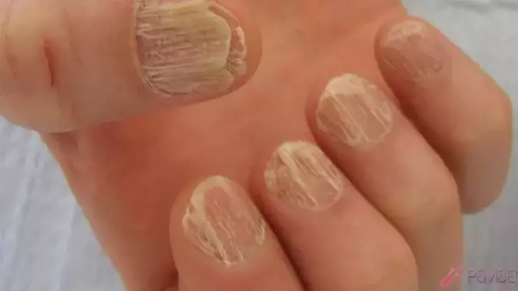 Mantarlı Tırnak Enfeksiyonu