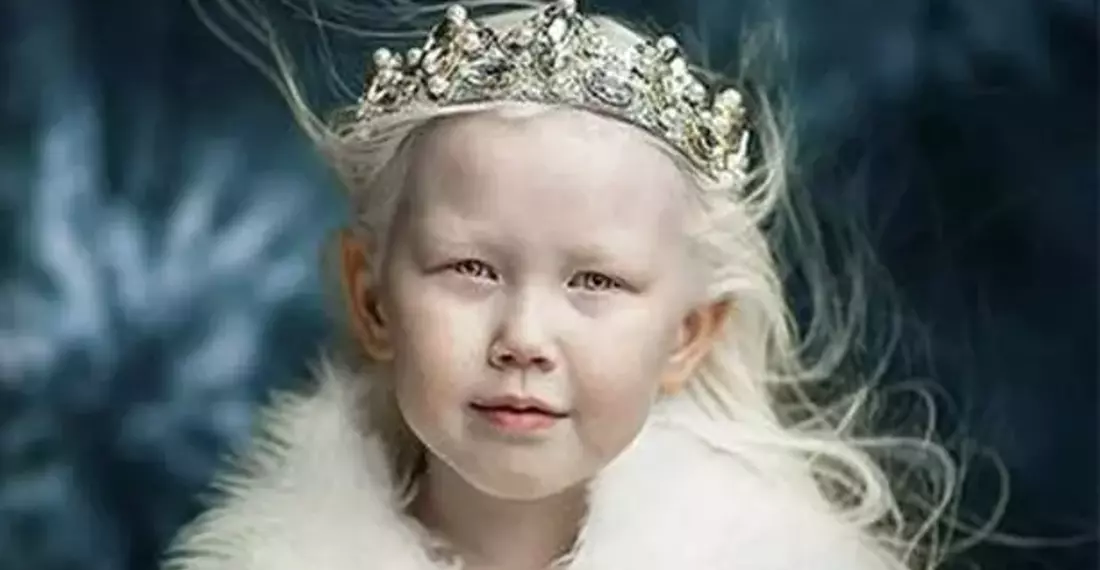 Albinizim Nedir?  Belirtileri, Nedenleri ve Tedavisi